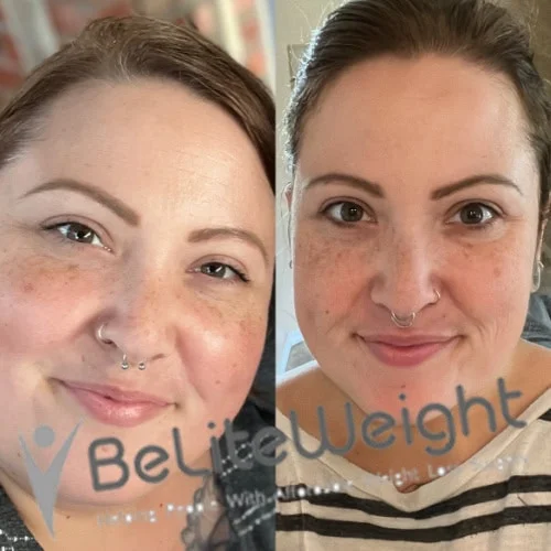 Weight Loss Surgery Before And After